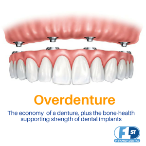 affordable tooth replacement options - overdentures