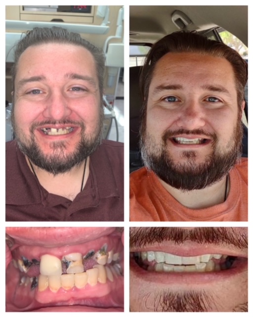 Brian, 35yo, dental implant recipient by Summerlin Dental Solutions