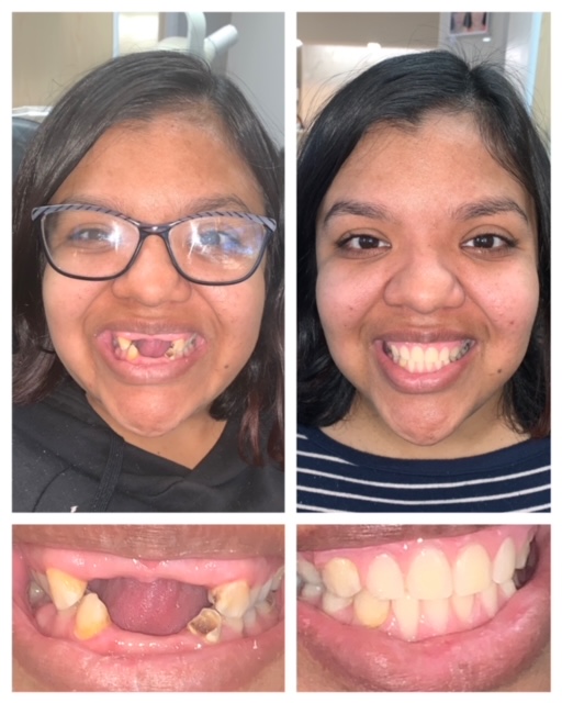 Justine, 23yo, dental implant recipient by Summerlin Dental Solutions